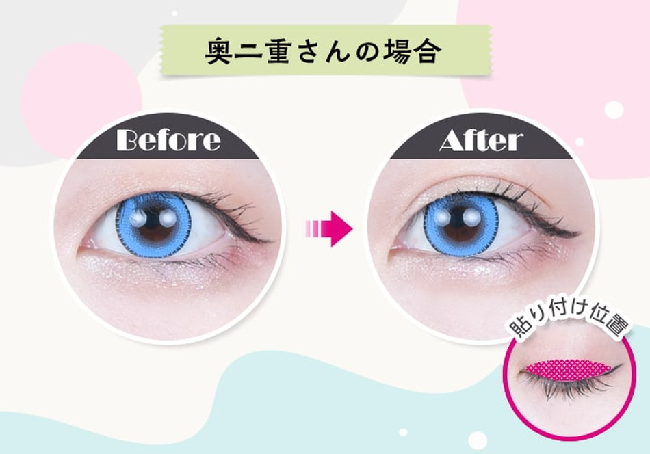 アシストAssist 二重メッシュAS 幅広タイプ(二重整形用メッシュシート)LP画像4